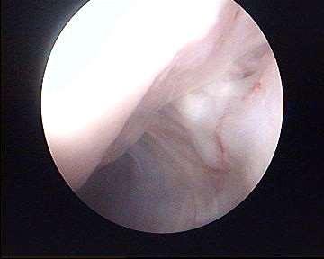 Humeral Head Bare Area Increase in size with age (DePalma) Size 6