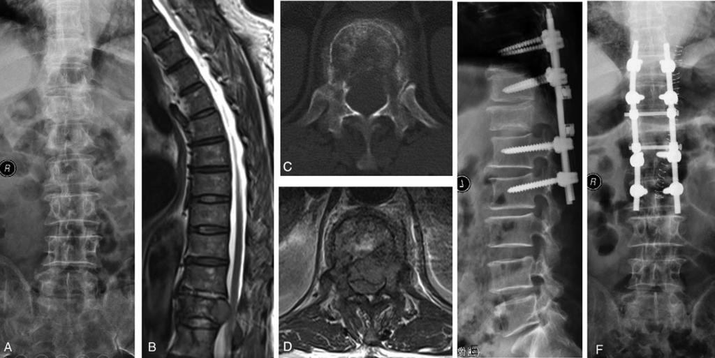 Figure 1. A 58-year-old man who was unable to walk due to metastatic spinal cord compression (MSCC) resulted from lung cancer. A, Preoperative X-ray presented vertebral collapse at T12.