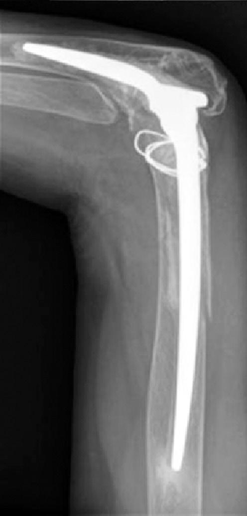 The previously inserted humeral stem interfered with the conventional screw insertion. Therefore, we decided to apply a PHILOS plate on this periprosthetic fracture.