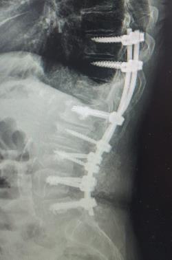 One was a deformity surgery of hemivertebrae at S1. The senior consultant used O-arm to insert pedicle screws.