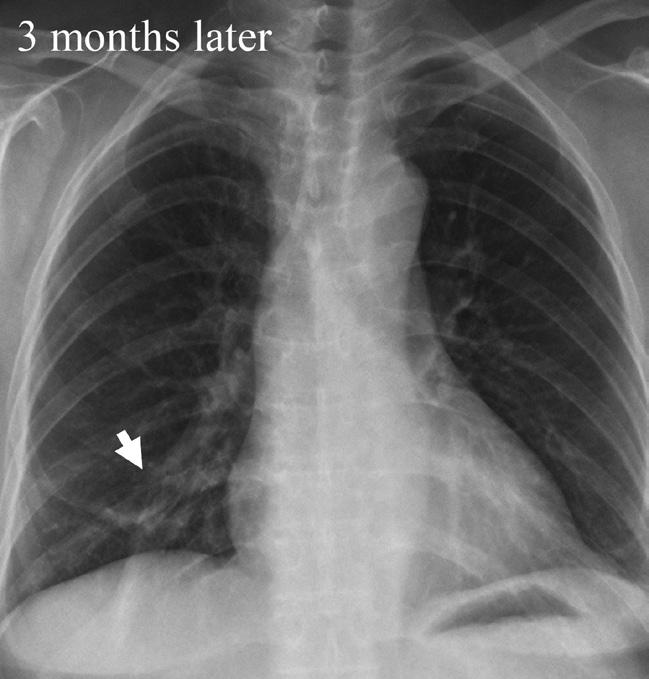 Chest X-ray and computed tomography (CT) revealed primary lung cancer (T2) in the right lower lobe with lymph node metastasis (N3) and lung-to-lung and bone metastasis (M1b).