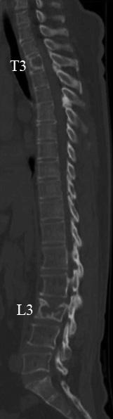 hancement at 27 months after surgery showed no evidence of recurrence at the T3 and L3 levels, and whole spine