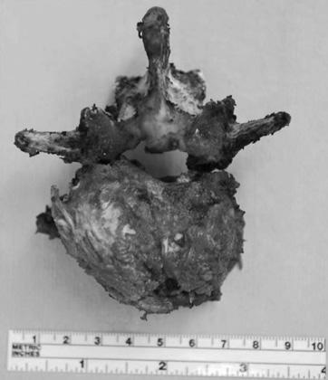 ony metastases at the T3 and L3 vertebral bodies were remarkable, and pathologic compression fracture at the L3