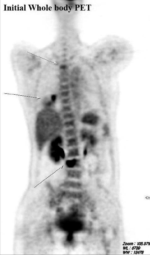 xial T1- weighted images with gadolinium enhancement show bony metastasis at the T3 and L3 vertebral bodies
