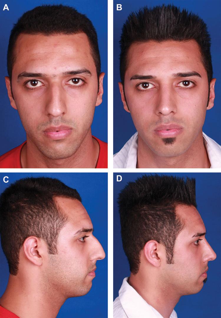690 Aesthetic Surgery Journal 34(5) Figure 1. (A, C) This 24-year-old man presented for rhinoplasty involving horizontal resection with cephalic hinged flap of the lateral crura.