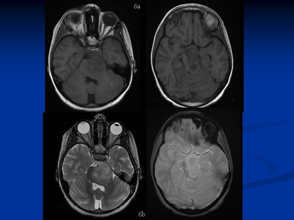 Fig. 6: The same patient figure 4 Transverse T1 weighted(upper images,6a)and T2(lower images, 6b) Infiltrative lesion located in the brainstem, specially in the left centre-lateral portion with an