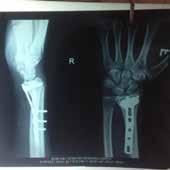 This dramatic shift may have been due to introduction and reported good results for volar locking plates for the treatment of distal radial fractures.