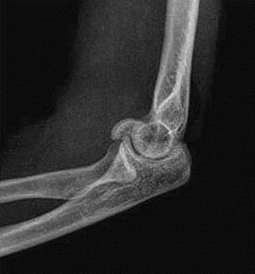 CAPITELLUM FRACTURES These represent <1% of all elbow fractures(1) It occur in the coronal