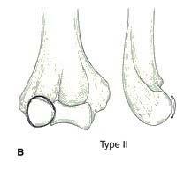 Classification Bryan and morrey classification Type 1 :large osseous component of capitellum, sometimes trochlear involvement.