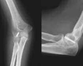 Treatment Nonoperative Used in non displace fractures It should immobilized in posterior splint for 3weeks followed by range of elbow motions. Operative The goal treatment is antatomical restoration.