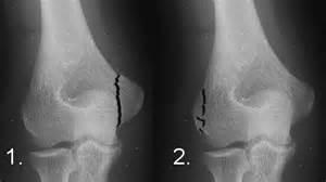 TROCHLEA FRACTURES It is very rare fracture It is associated with the elbow dislocation Treatment Undisplaced fractures are managed with