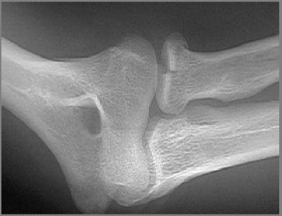 Radial head fractures It is common in adult Radial head fractures accounts