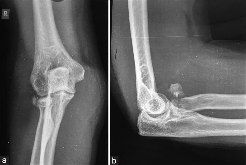 Investigations Radiographs Anteroposterior and lateral radiographs of elbow to be