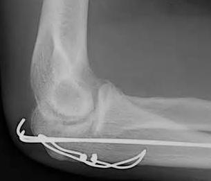Operative treatment Indications are 1. Displaced fractures 2.