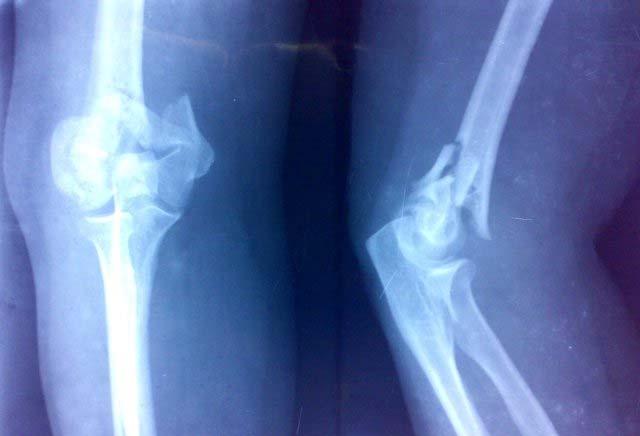 Radiographic evalution Standard anteroposterior and lateral views of elbow should be