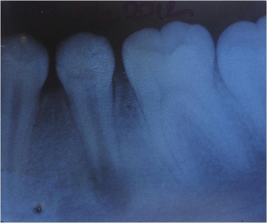 PRP in the treatment of immature tooth and differentiation. 9 In the literature there are several case reports which use PRP in the treatment of tooth with necrotic pulp and open apex.