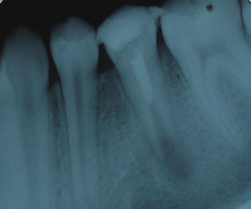 Case report 10-year-old female patient was referred to the Department of Pediatric Dentistry complaining of swelling of the left permanent mandibular second premolar.