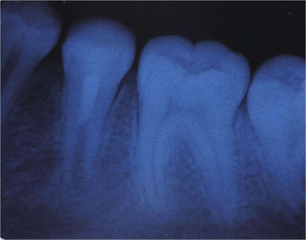 Güven Polat G et al. Figure 3. Periapical radiograph of the left permanent mandibular second premolar six months after treatment. Figure 4.