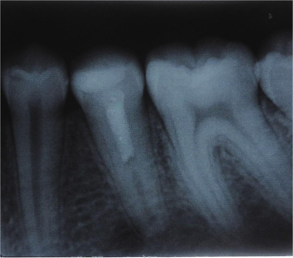 The radiographic presentation of the radiolucency was healed and the root continued to develop (Figure 3). At the 2-year recall, the root of the tooth was fully developed (Figure 4).