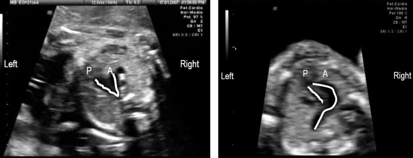 A new ultrasound marker of tetralogy of Fallot 557 of, TOF in the fetus, and to evaluate its frequency in fetuses with TOF as compared with those with other cardiac defects and normal cardiac scans.