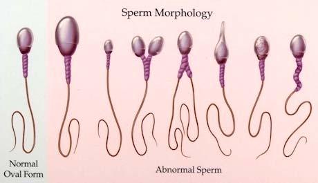 Sperm morphology and motility Infertile