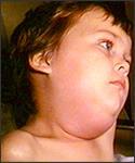 Mumps Mumps is caused by a virus and transmitted by respiratory droplets. Incubation is 14-18 days. In 2009, there were over 6,000 mumps cases in the United States.