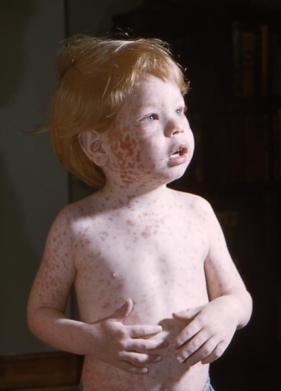 Rubella Rubella (German Measles) is a viral infection that causes a fever and a rash. Transmission occurs through personal contact via respiratory droplets. Incubation is 12 23 days.