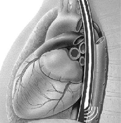 TE aortic Doppler Gan