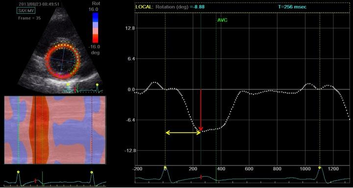 Severitatea regurgitării aortice a fost evaluată conform recomandărilor Asociației Europeane de Imagistică Cardiovasculară 37 și au fost incluși pacienții cu regurgitare aortică semnificativă