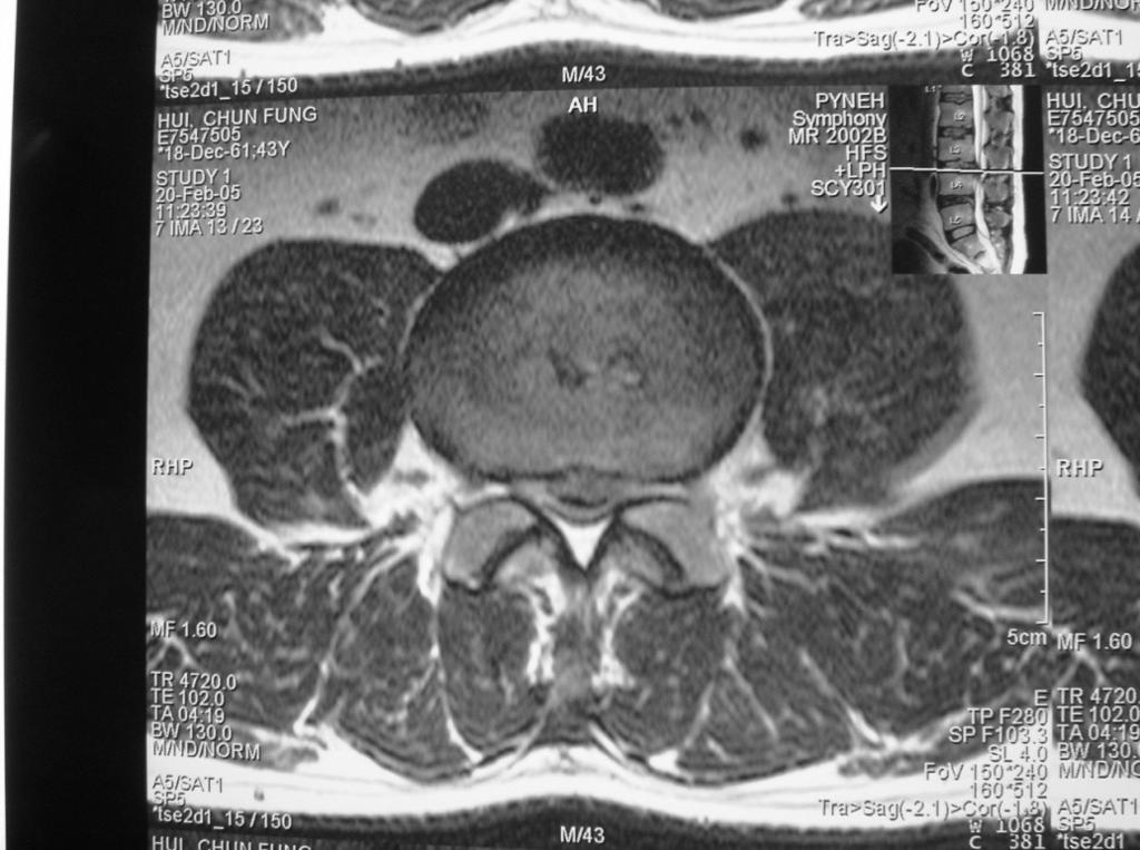 (herniation) from image Balance: