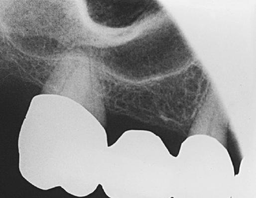 Cone Cut From Frommer HH, Stabulus JJ: Radiology for the dental professional,