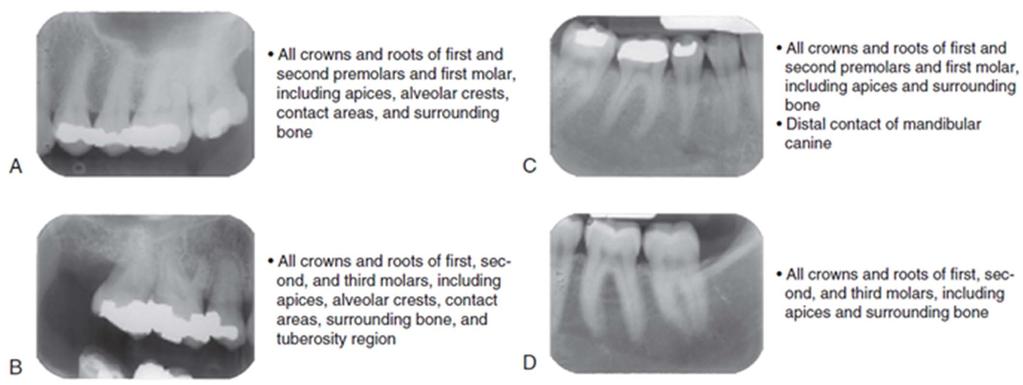 Posterior Periapical Film Placement From Iannucci J, Jansen Howerton L: Dental radiography: