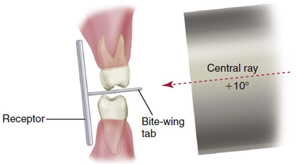 Bitewing Technique: Vertical Angulation From Iannucci J, Jansen Howerton L: Dental radiography: