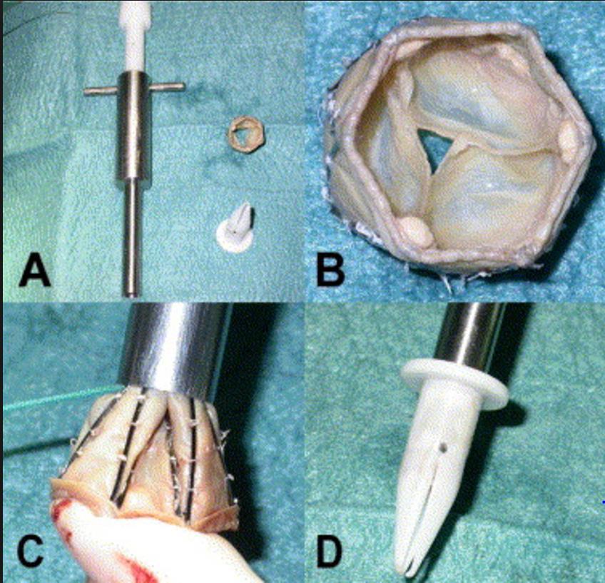 Surgical innovation Injectable pulmonary valve, ongoing INVITE study Avoids