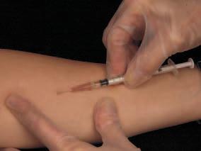Administration of the Mantoux test
