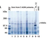 CADM-0 (MDA) autoantibody First described in Japan (9 - % DM and - 7% CADM), recently US 0 patients
