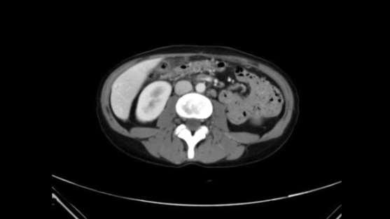 2009: Second recurrence on colostomy site abscess and