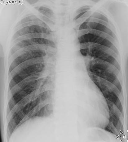 Surgical Treatment for MDR-TB : Siriraj Experience Cavity 3, bronchiectasis 3,