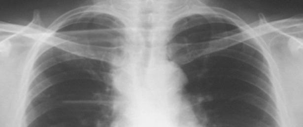 A 60-year-old man, previously healthy referred for treatment of MDR-TB.