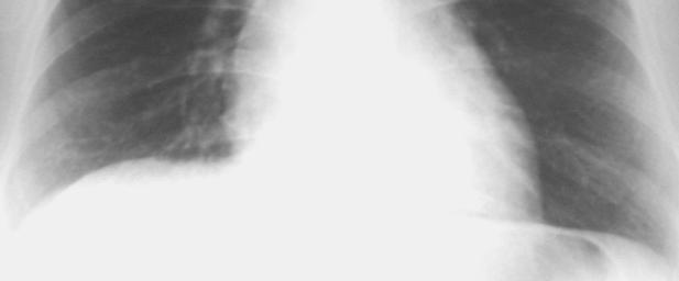 His CXR was markedly improved with few residual scarring, but smears were persistently positive.