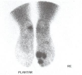 Rheumatoid arthritis in the small joints of feet