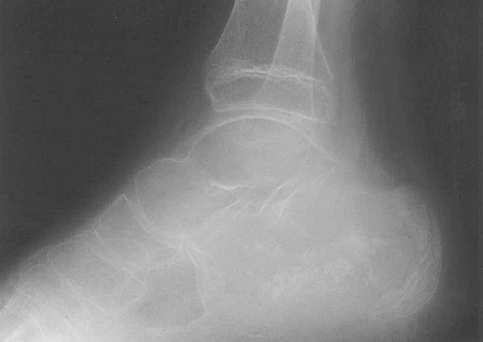 46 E. M. Elek et al. Fig. 1. Lateral radiograph of ankle and hindfoot showing a lytic expansile lesion of the calcaneus containing some cartilage mineralization.