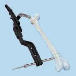 The compression instrument can be attached to the blade and intraoperative compression is obtained over the buttress nut and the protection sleeve.