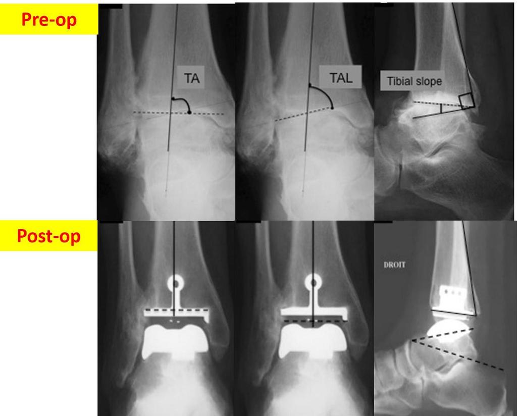 Patients & Methods Radiographic measurements (pre & post operation) tibial angle