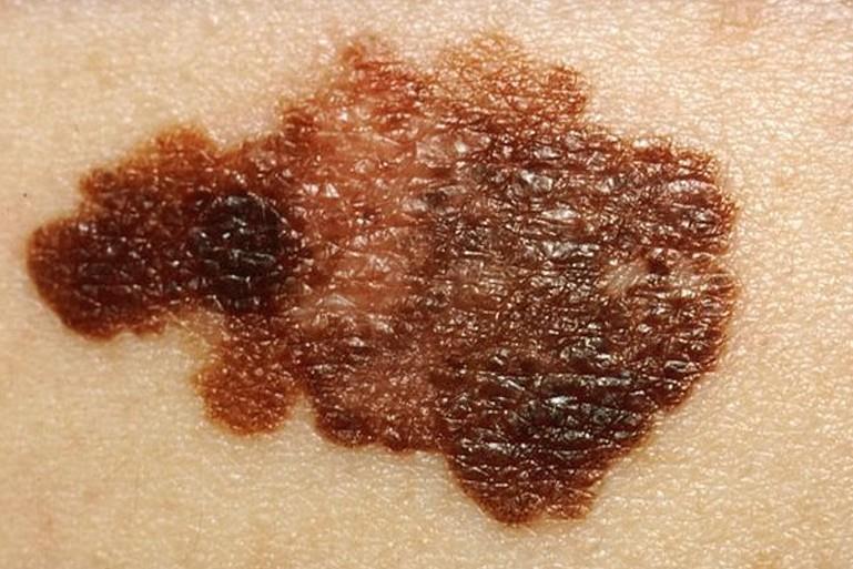 Slika 1. Površinsko šireći melanom - Nodularni melanom (NM) NM je drugi tip melanoma po učestalosti. Pojavljuje se u 15 30 % svih melanoma.