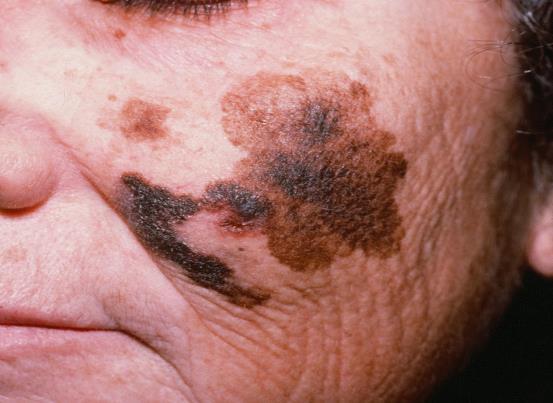 - Lentigo maligni melanom (LMM) Ovaj oblik čini 15 % melanoma, najčešće se javlja u sedmom desetljeću života.