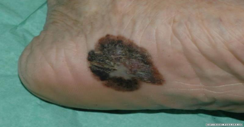 Lentigo maligna melanom Riječ je o smeđoj, nejednoliko pigmentiranoj makuli, različitih oblika koja se odlikuje dugom horizontalnom fazom rasta.