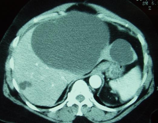 Question 2 A 40-year old female presents with dull left upper quadrant pain and presents with the following imaging after attempted aspiration. Which of the following is the best treatment?