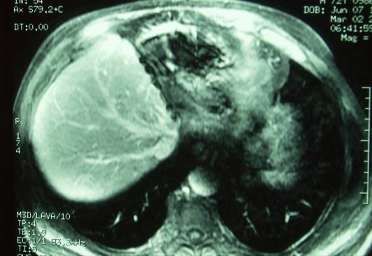 LIVER BILIARY CYSTADENOMA Question 2 ~ Answer A 40-year old female presents with dull left upper quadrant pain and presents with the following imaging after attempted aspiration.