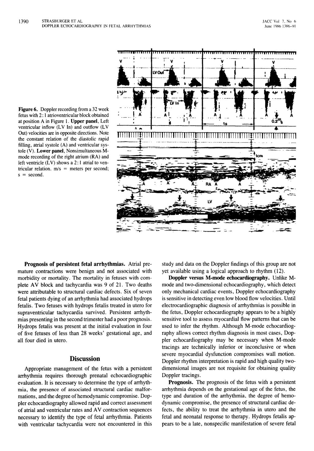 1390 STRASBURGER ET AL DOPPLER ECHOCARDIOGRAPHY IN FETAL ARRHYTHMIAS lacc Vol 7. No 11 June 19X6 I3X6-91 Figure 6.